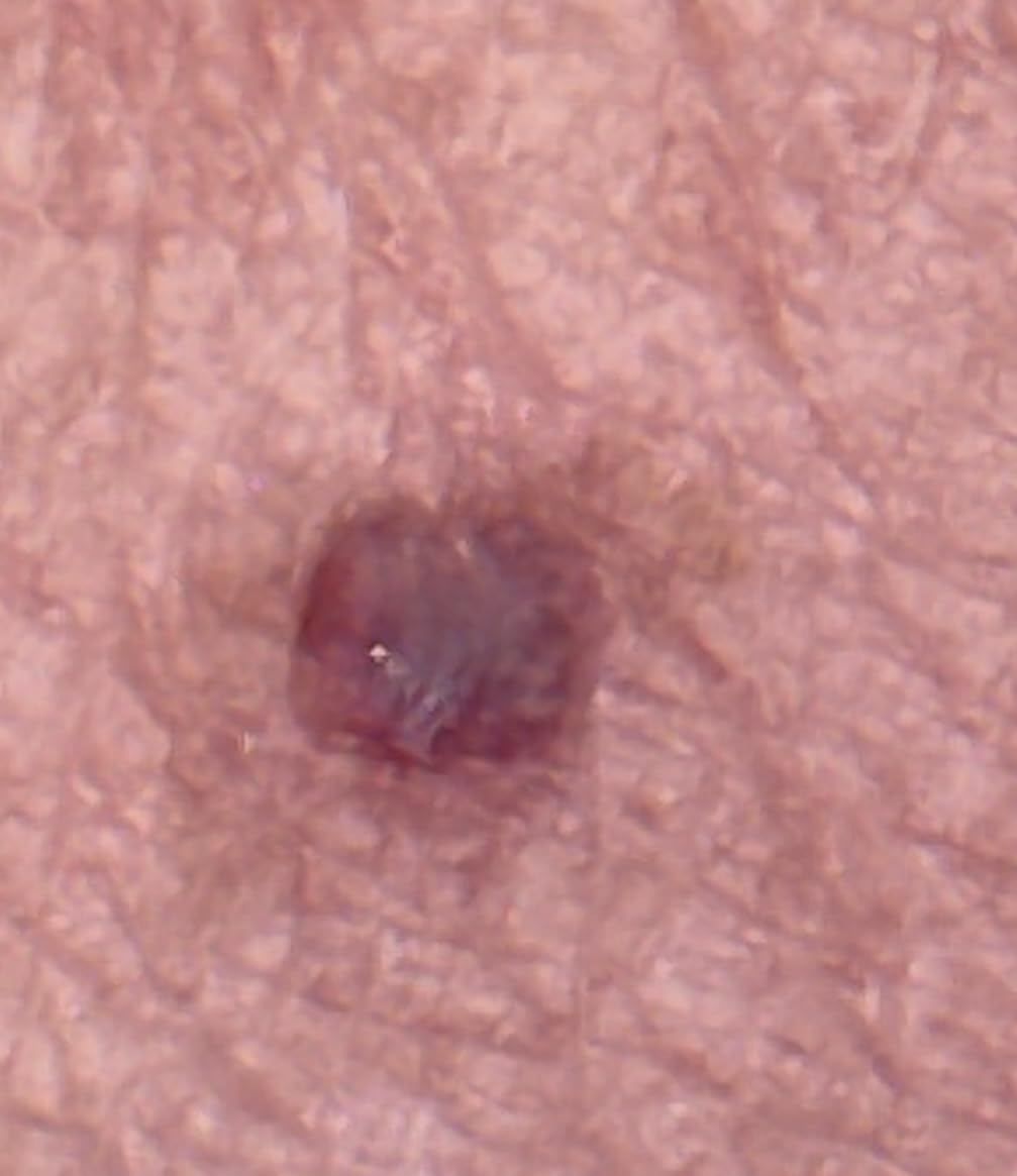 Neviscope Black Phone Dermatoscope Microscope with Polarized Lens/LED Light, 100x Camera Attachment with Universal Clip for Most iPhone/Android Phones Free App customer photo 1