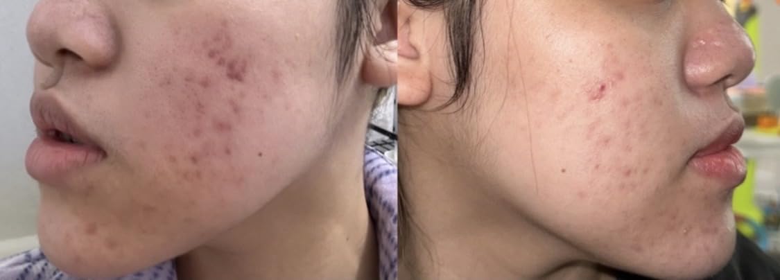 Paula's Choice SKIN PERFECTING 2% BHA Liquid Exfoliant with Salicylic Acid, Facial Polish for Pores, Wrinkles & Fine Lines, Fragrance-Free customer photo 1