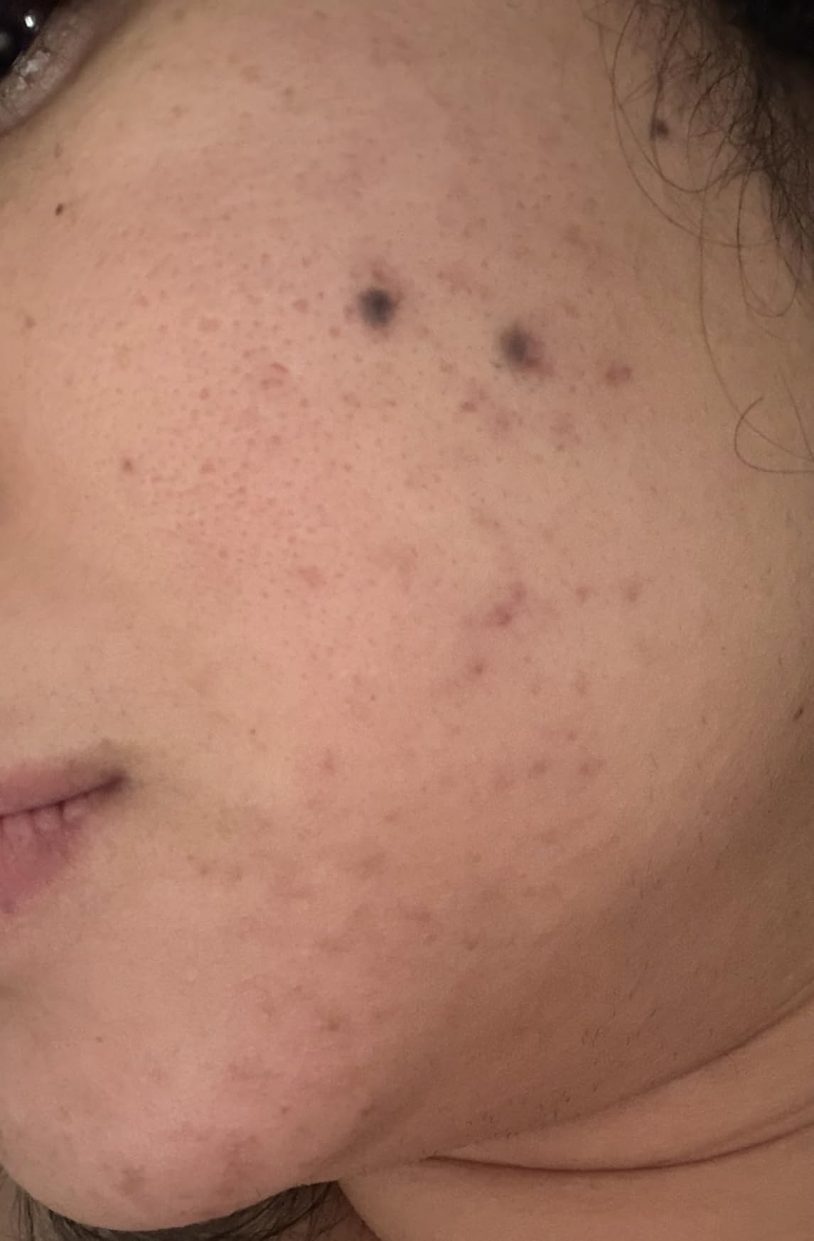 Resurfacing Retinol Serum For Post Acne Marks, Formulated With Licorice Root Extract & Niacinamide, Brightening Serum & Pore Minimizer For Face, Post Acne Skin Barrier Repair, Non-Comedogenic customer photo 1