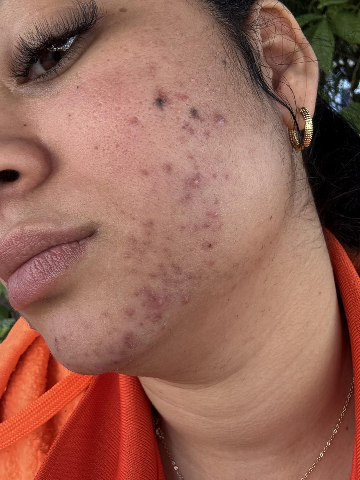 Resurfacing Retinol Serum For Post Acne Marks, Formulated With Licorice Root Extract & Niacinamide, Brightening Serum & Pore Minimizer For Face, Post Acne Skin Barrier Repair, Non-Comedogenic customer photo 2