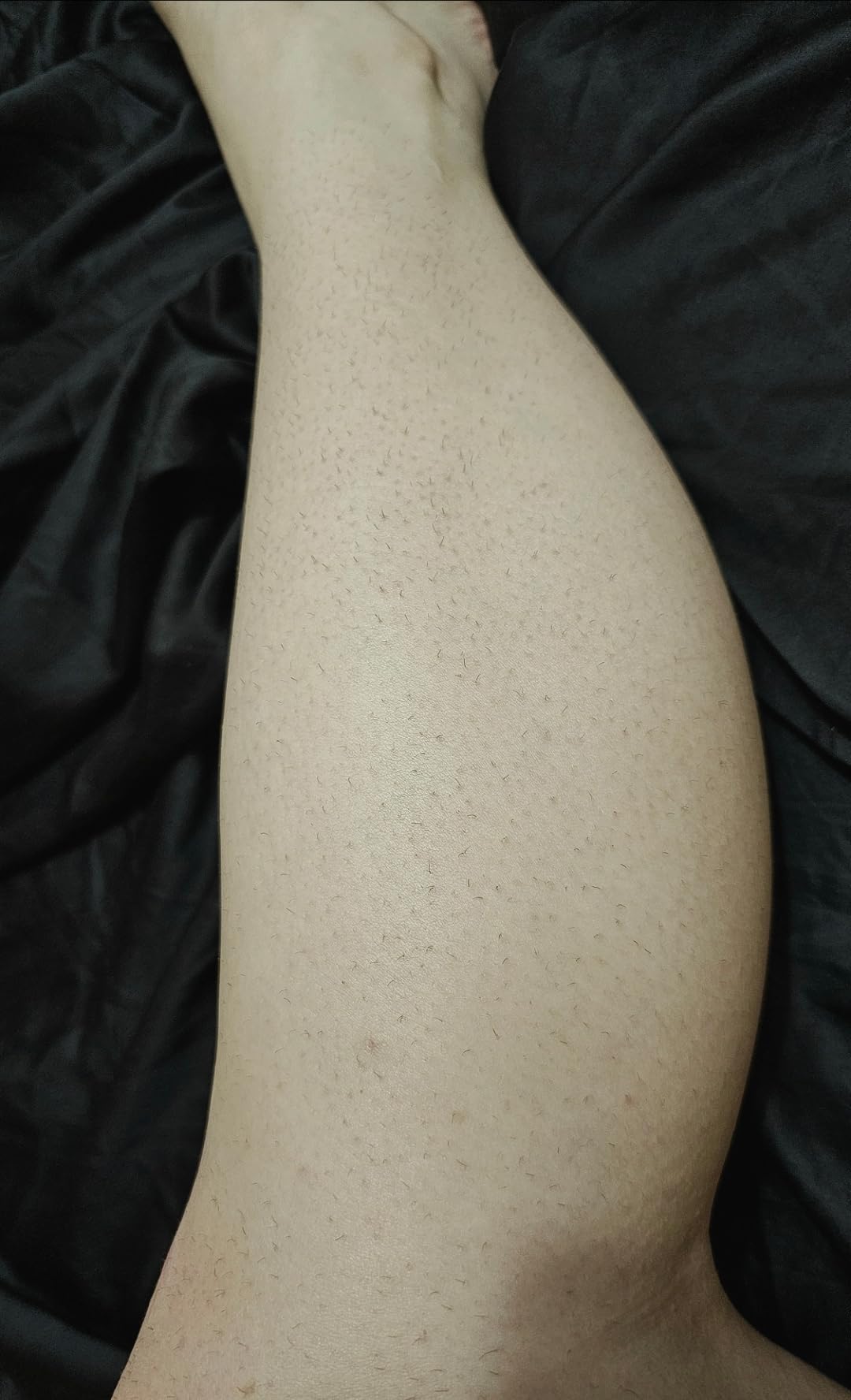 Philips Lumea 9000 Series IPL Hair Removal Device Permanent Laser Hair Reduction for Women & Men, Easy and Comfortable Use at Home, SenseIQ, 4 Attachments for Body, Face, Bikini & Underarms, BRI984/03 customer photo 1