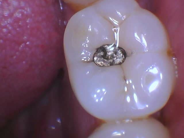 ProDENT Intraoral Camera PD740 Teledentistry Partner Capture Button Work with Dexis, Eaglesoft, Carestream and More (Blue) customer photo 1